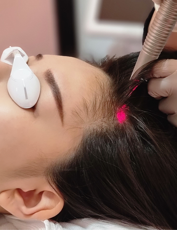 Woman undergoing hair loss treatment Singapore.