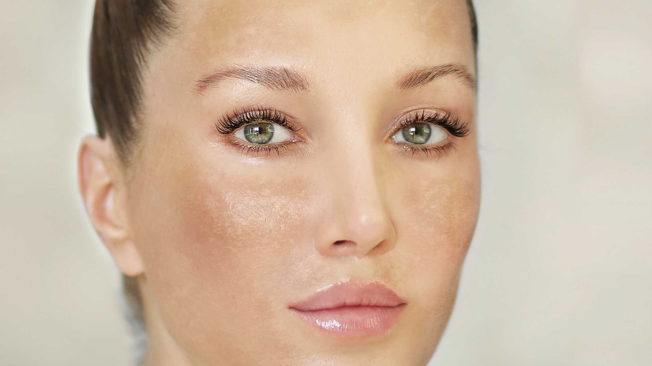 Interestingly, researchers later observed that the same biological pathway involved in clot regulation may also influence pigment activation within the skin. This discovery opened new possibilities in dermatologic and aesthetic applications, particularly for conditions such as melasma.