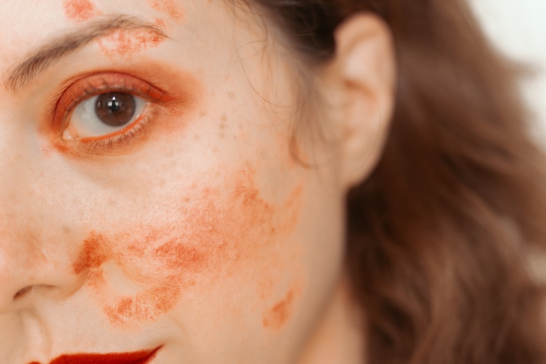 Photo laser pigmentation
